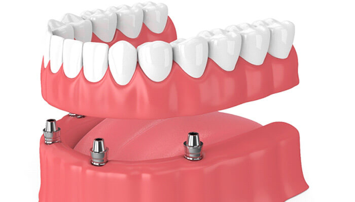 illustration of implant dentures in st. peters, mo