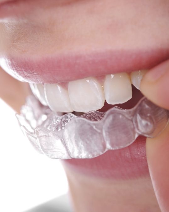 Close up of a person placing an Invisalign aligner over their upper teeth