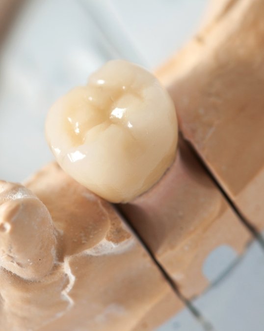 Zirconia dental crown in a model of a row of teeth