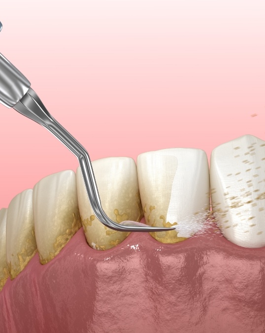 Animated dental tools removing plaque buildup during periodontal therapy