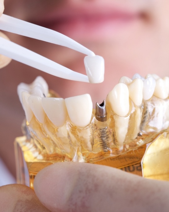 Dentist placing a dental crown atop a dental implant in a model of the jaw