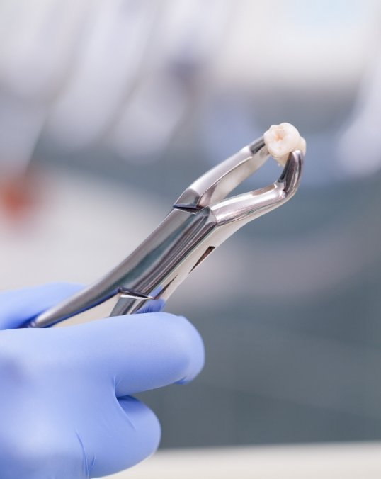 Extracted tooth being held in a pair of dental forceps