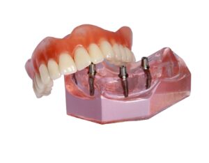 Set of implant dentures with model implants in a pink translucent base